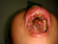 Orale mycomycosis