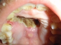 Orale mycomycosis